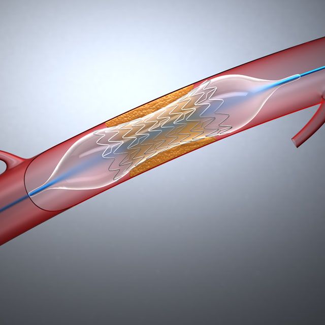 Hartstents (Stent)