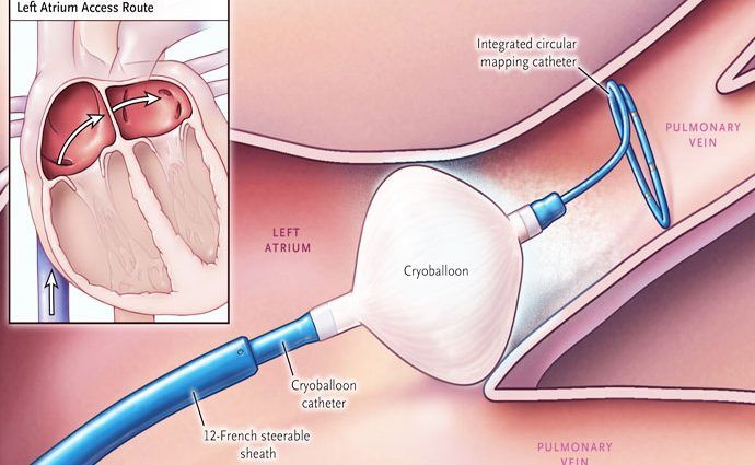 Ablatie, Cryoablatie