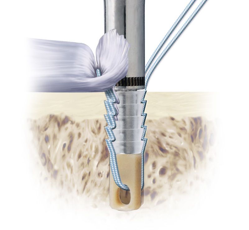  Bio-Force Soft Anchor in chirurgische scenario's