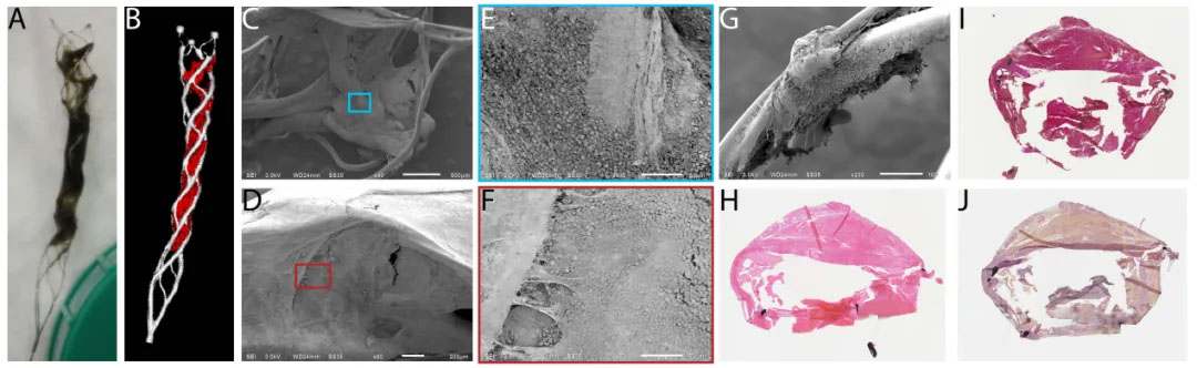 Hoge-resolutie beeldvorming van de interactie tussen trombus en stent-retriever bij patiënten met acute ischemische beroerte