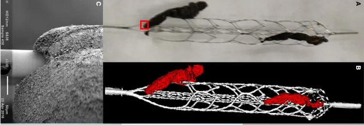 Hoge-resolutie beeldvorming van de interactie tussen trombus en stent-retriever bij patiënten met acute ischemische beroerte